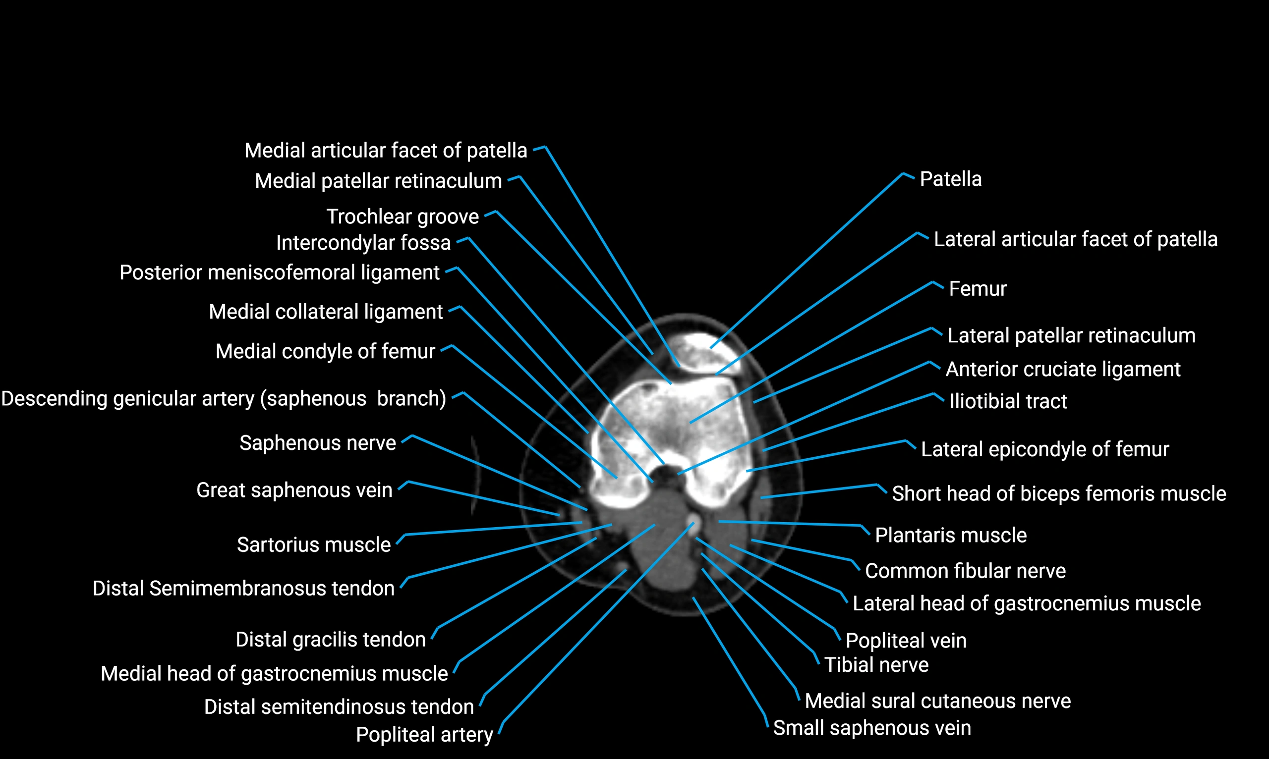 CT lower limb axial cross sectional anatomy labelled image 85 (2).webp